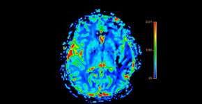 Alzheimer pode começar aos 20 e mudar tudo o que você achava saber