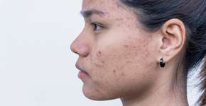 Estudo: remédio para pressão alta ajuda a suavizar acne adulta