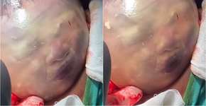 Vídeo mostra rosto de bebê se mexendo dentro do saco amniótico