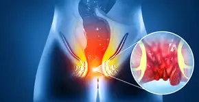 Este alimento pode ajudar quem tem hemorroidas; veja benefícios