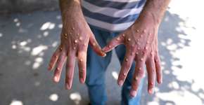 SP cria rede com 93 hospitais para enfrentar varíola do macaco