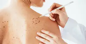 Câncer de pele: método simples ajuda a identificar pinta suspeita