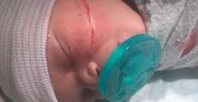 Bebê tem corte no rosto em cesárea de emergência