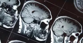 Demência: metade dos casos podem ser prevenidos; saiba como