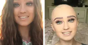 Blogueira se abre sobre a alopecia para empoderar outras pessoas