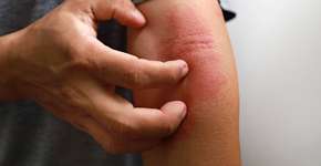 Harvard aponta para causa até então desconhecida da coceira