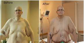 Homem que pesava 444 kg relata seu processo de emagrecimento