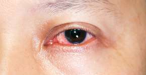 Nova técnica promete revolucionar tratamento de melanoma ocular