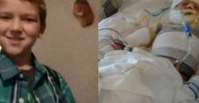 Vítima de bullying, menino tem 20% do corpo queimado com gasolina