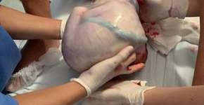 Bebê nasce dentro da bolsa em parto raro em Santa Catarina