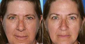 Estudo compara aparência de gêmeos fumantes e não-fumantes