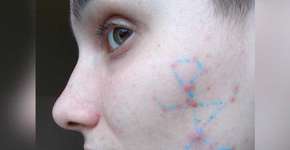 Artista faz constelações com sua acne para inspirar positividade