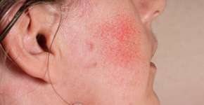 Entenda a ligação entre rosácea e questões emocionais