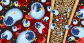 Dor nos ossos é um dos principais sintomas desse tipo de câncer