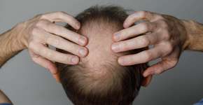Queda de cabelo em homens: entenda as causas e saiba como lidar