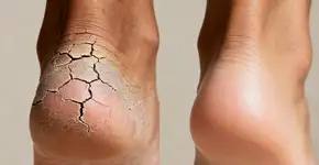 Como acabar com pés rachados com hidratação correta