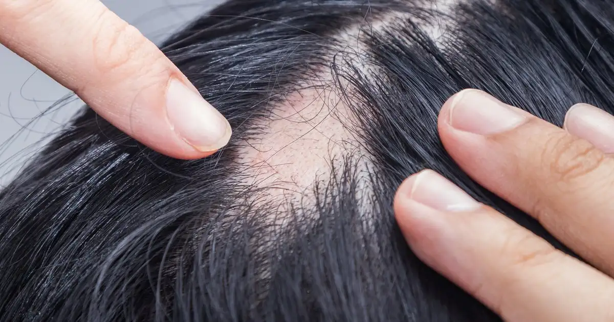 Alopecia areata: entenda o que é, suas características e tratamento