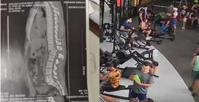 Tomografia mostra lesão de aluno que se acidentou na academia