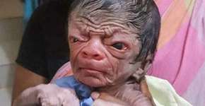 Bebê nasce com doença rara e lembra caso de Benjamin Button