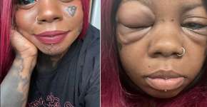 Reação alérgica à tatuagem no globo ocular pode deixar mulher cega