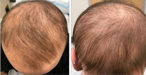 Remédio para eczema pode combater calvície