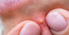 Foto: (iStock/andriano_cz)