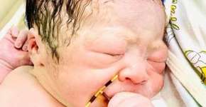 Bebê surpreende médicos ao nascer junto com DIU da mãe