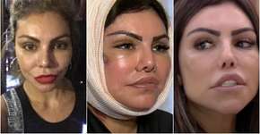 Aparência de Liziane Gutierrez expõe os riscos da harmonização