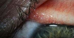 Mulher tem 14 vermes extraídos do olho em caso único no mundo