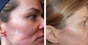 Artista cria técnica de tatuagem para camuflar cicatrizes