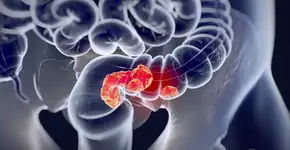 Exame que pode prevenir câncer de intestino deve ser realizado periodicamente