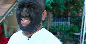 Homem com doença genética rara tem 98% do corpo coberto de pelo