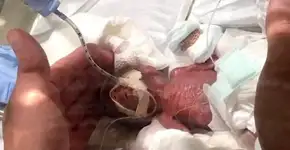 Recém-nascido que cabia na mão do médico sobrevive e ganha alta