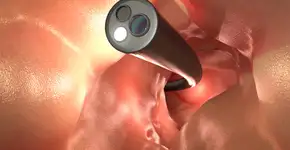 Quatro sinais de que você deve fazer colonoscopia antes dos 45