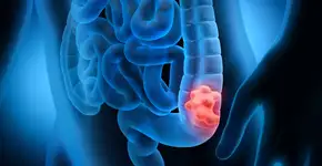 Novo exame de fezes que usa IA pode detectar 90% dos casos de câncer de intestino