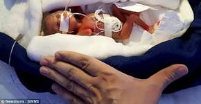 Bebê prematura que pesava menos que barra de chocolate sobrevive