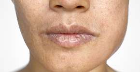 Câncer de intestino: indício incomum da doença aparece no rosto