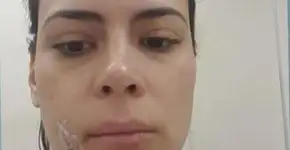 Jornalista da Globo é mordida no rosto por sua cadela e leva 20 pontos