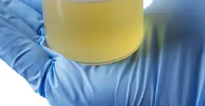 Urina com espuma pode ser problema de saúde