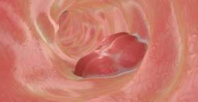 Saiba o que aumenta o risco de câncer colorretal em jovens