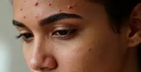 Aloe vera é o tratamento mais poderoso contra acne fúngica resistente