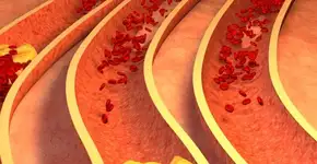 Como controlar o colesterol alto?