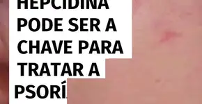 Hepcidina pode ser a chave para tratar a psoríase