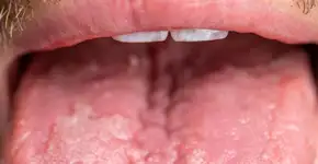 Os sinais de alerta na língua