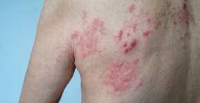 Pesquisadores descobrem que risco de herpes-zóster é maior após covid