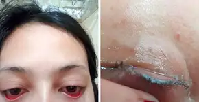 Mulher revela sofrimento após ter os cílios colados com supercola
