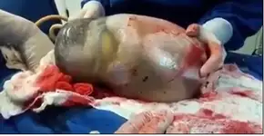 Um a cada 80 mil: vídeo registra parto empelicado de bebê gêmeo