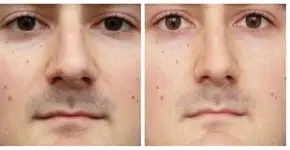 Entenda por que a selfie distorce e aumenta seu nariz