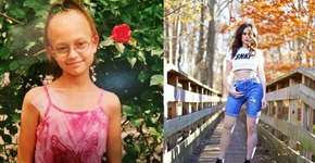 Garota de 8 anos faz performance meses após ter perna amputada