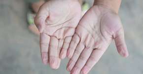 Covid: pacientes relatam dedos enrugados e outros sintomas estranhos